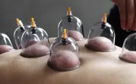 হিজামা কাপিং থেরাপি