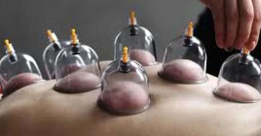 হিজামা কাপিং থেরাপি